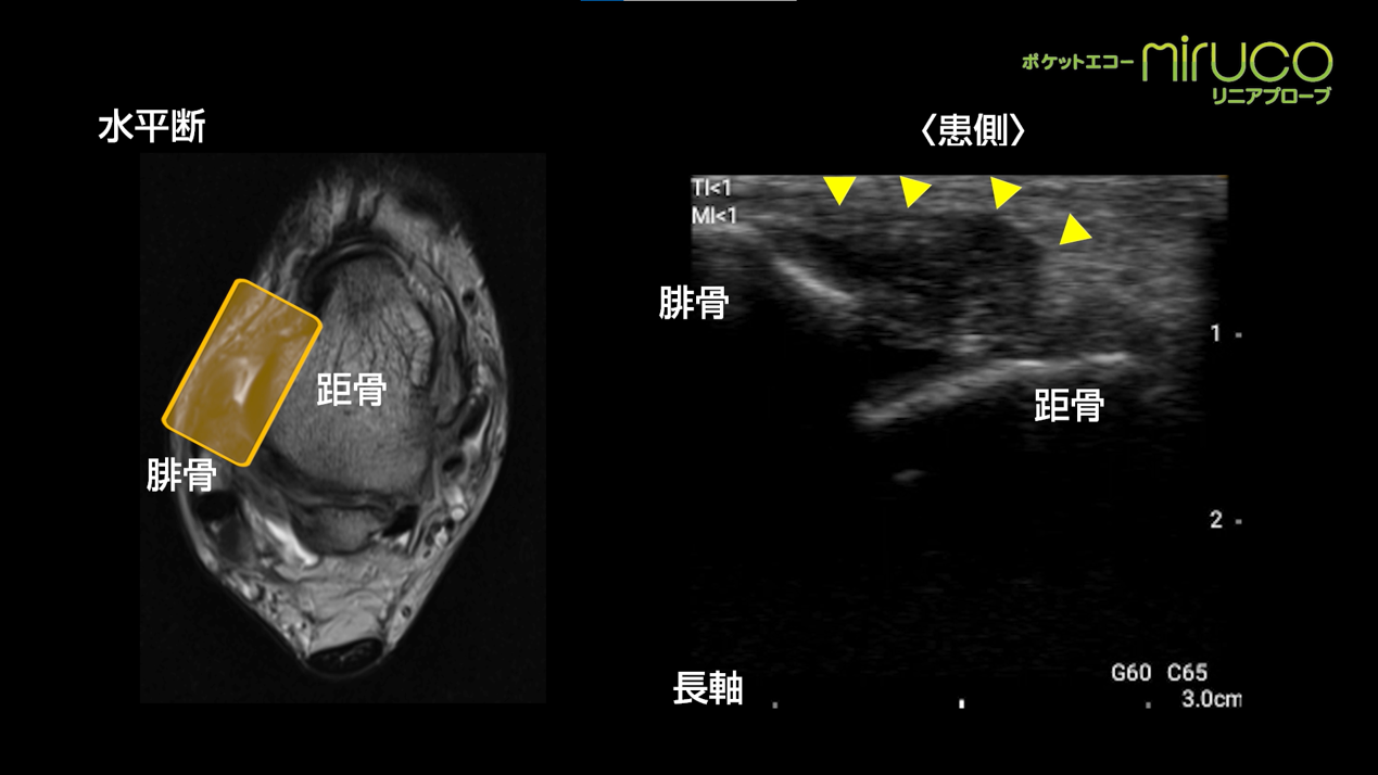 ポケットエコー Miruco でみる スポーツ現場で遭遇する症例 靭帯損傷編 肘内側側副靭帯損傷 膝内側側副靭帯損傷 前距腓靭帯損傷 前下脛腓靭帯損傷 の動画を公開しました 日本シグマックス整形外科領域 総合情報サイト Sigmax Medical