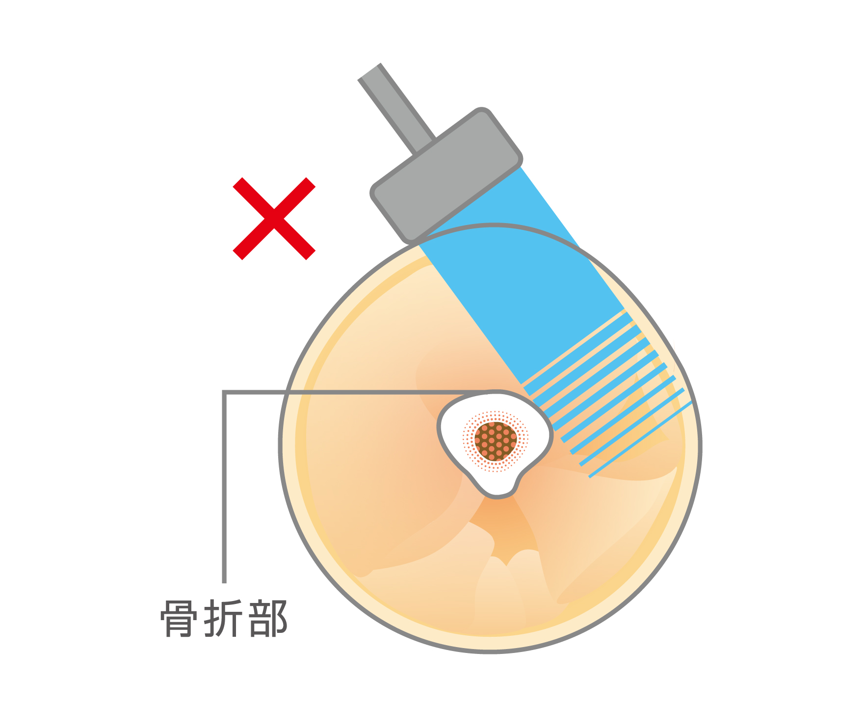 骨折部①