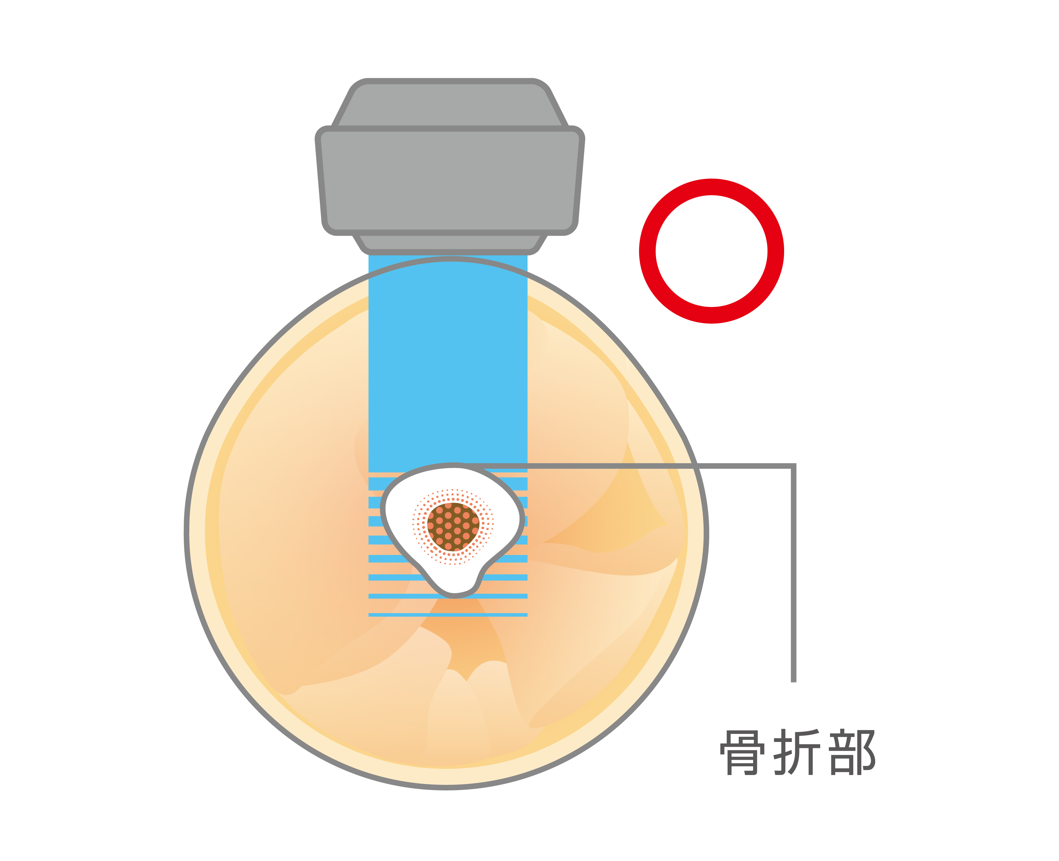 骨折部②