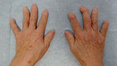 典型的なヘバーデン結節例