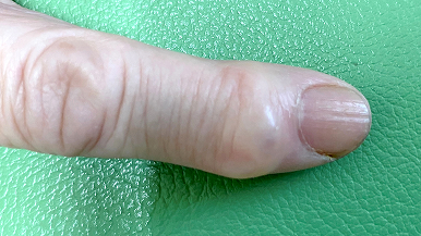 典型的なミューカスシスト例