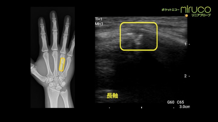 骨折編【中手骨骨折/肋軟骨骨折】